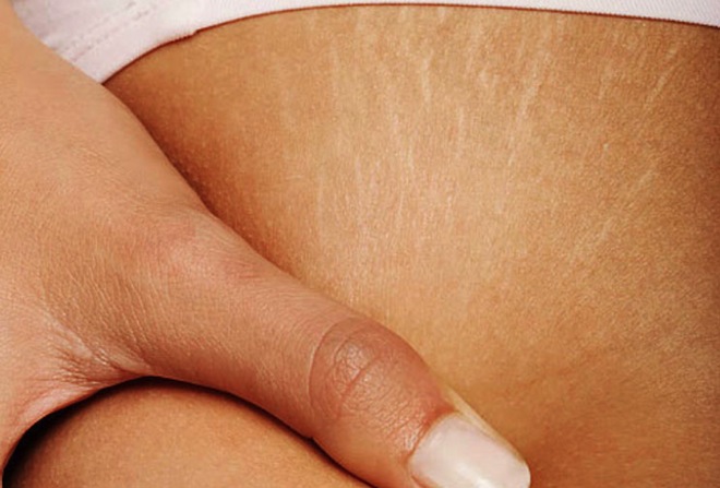 cara menghilangkan stretch mark secara alami