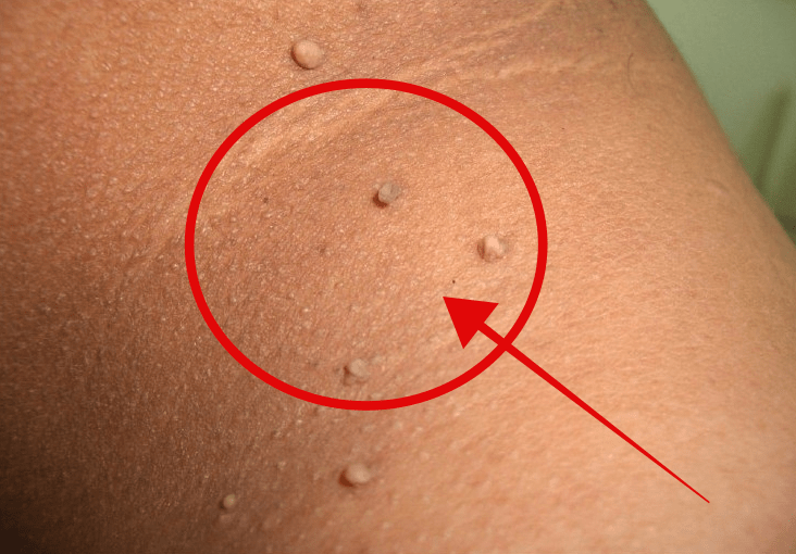 cara menghilangkan skin tag secara alami dan mudah