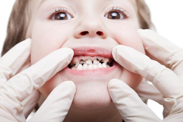 penyebab karies gigi pada anak